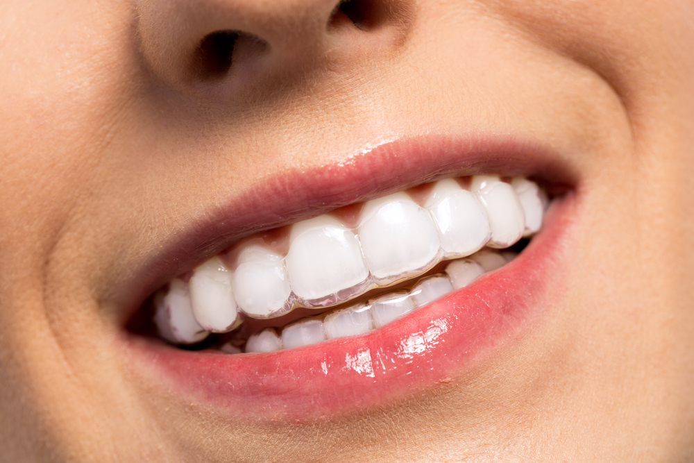shutterstock 403074949 Achieving Your Best Smile with Invisalign