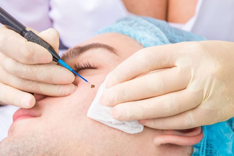 Askin dermatology surgical scaled 1 What Are The Most Common Methods For Mole Removal, And How Do They Work?