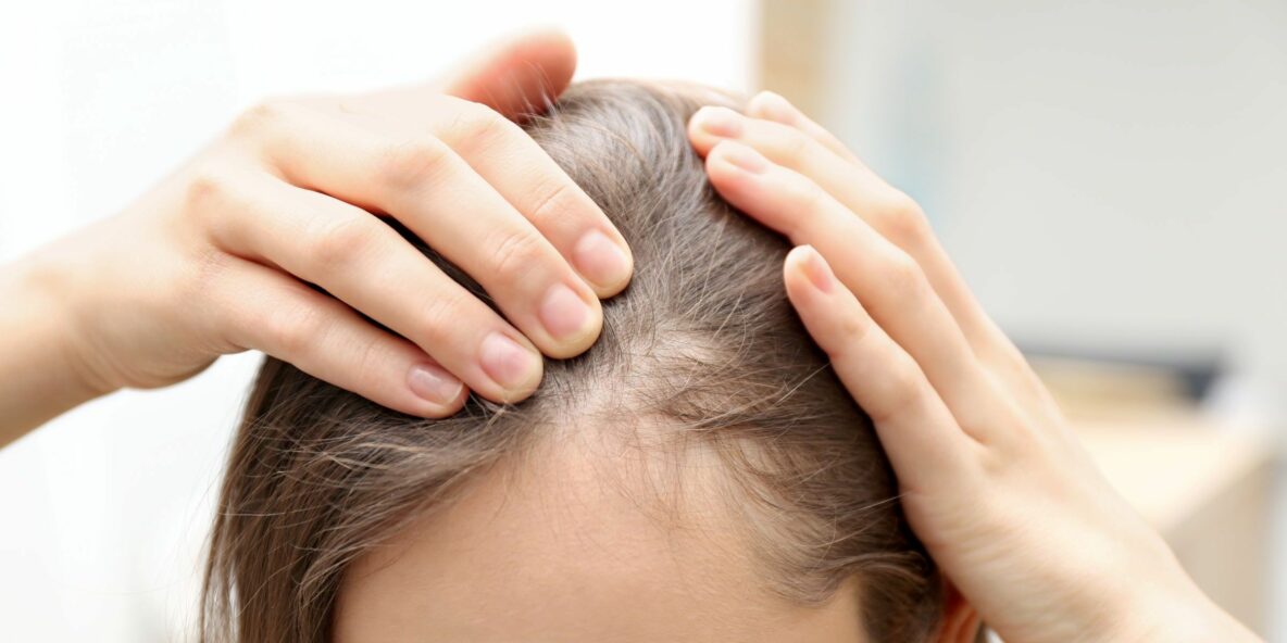 Frontal Fibrosing Alopecia 1184x592 1 How Autoimmune Disorders Can Trigger Hair Loss: Understanding The Connection