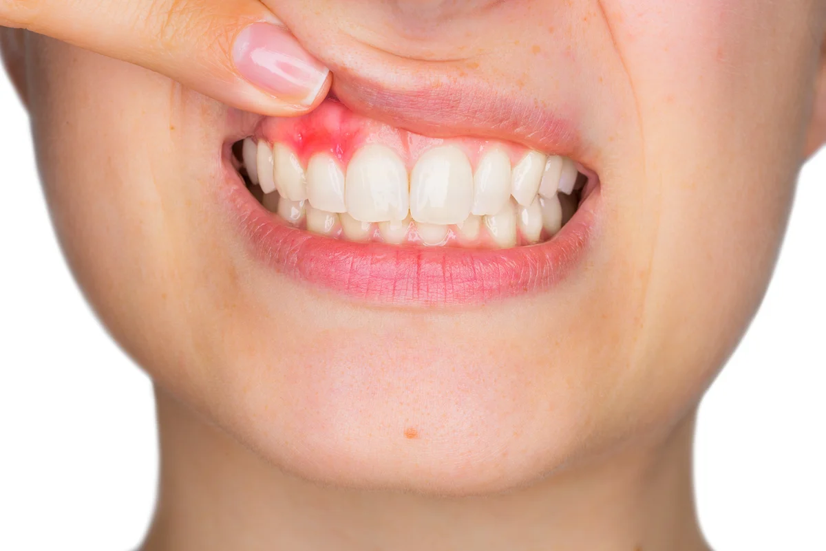 woman pointing to inflamed gum Remèdes Naturels pour les Abcès Dentaires : Combiner la Brosse à Dents Électrique Oclean Kids avec des Alternatives aux Antibiotiques