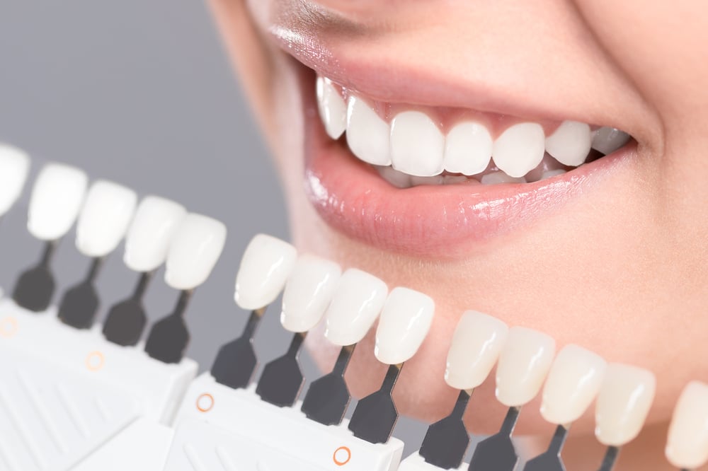 shutterstock 613465190 1 Your Guide to Teeth Whitening Solutions Offered in Kelowna