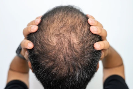 Screenshot 53 Can Estrogen Reverse Male Pattern Baldness?