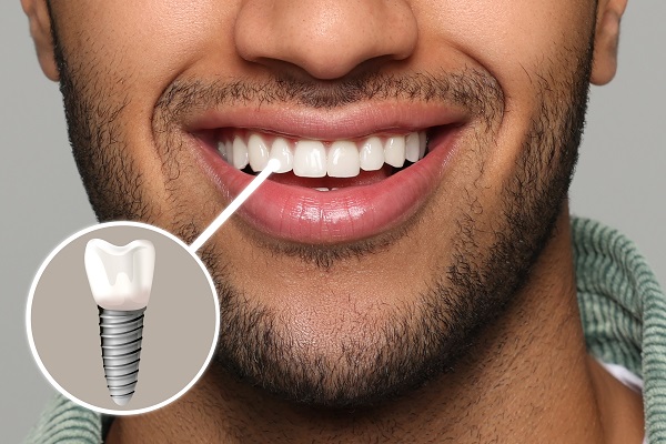 dental implants independence A Bright Smile: Understanding the Benefits of Dental Implants