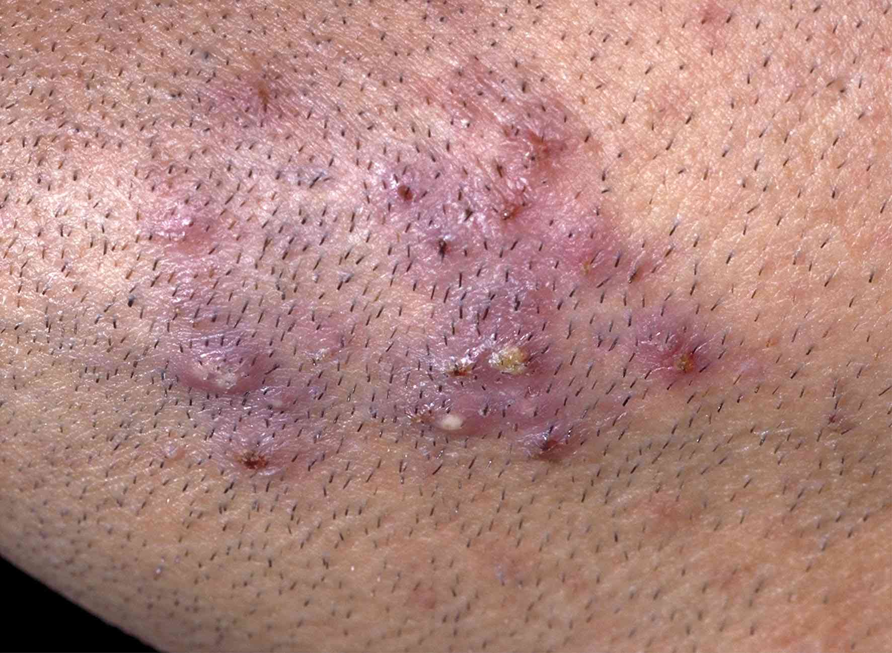 Ingrown Hair Infection: Causes, Symptoms, and Home Remedies 1 VWH Dermnet FolliculitisBarbae IngrownHair 01 2ca546078c474958911538ddf25f5d69 Ingrown Hair Infection: Causes, Symptoms, and Home Remedies