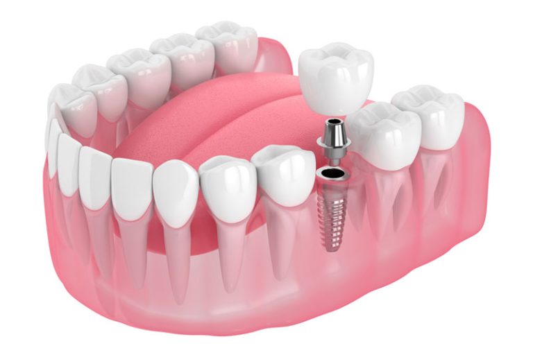 single dental implant New Trends in Dental Implant Care: A Guide for Patients and Professionals