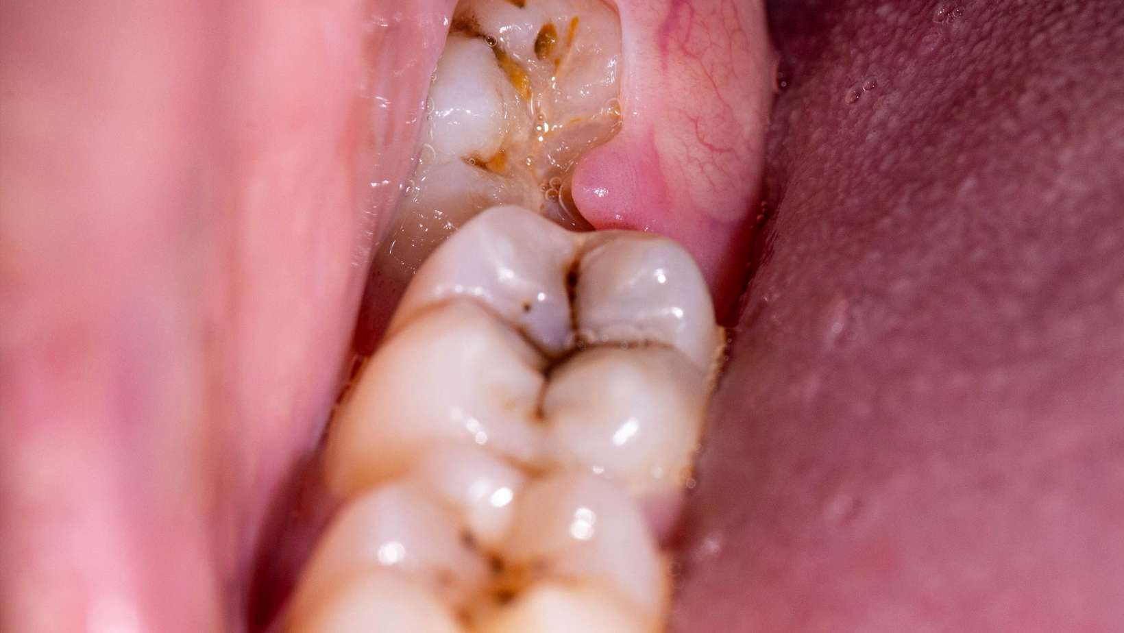 10 Warning Signs That Indicate You Should Consider Wisdom Teeth Removal 1 How to Know If You Need Wisdom Teeth Extraction