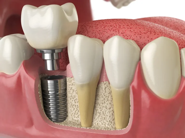 65679d1cc931ecd6f01999f4 AdobeStock 183186695.jpeg The Benefits of Restoring Missing Teeth: More Than Just Aesthetics