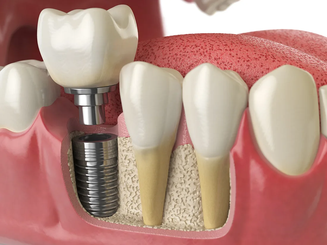 65679d1cc931ecd6f01999f4 AdobeStock 183186695.jpeg The Benefits of Restoring Missing Teeth: More Than Just Aesthetics