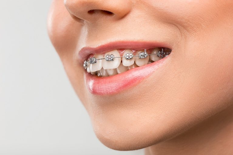 29 What Can Orthodontic Brackets Do?
