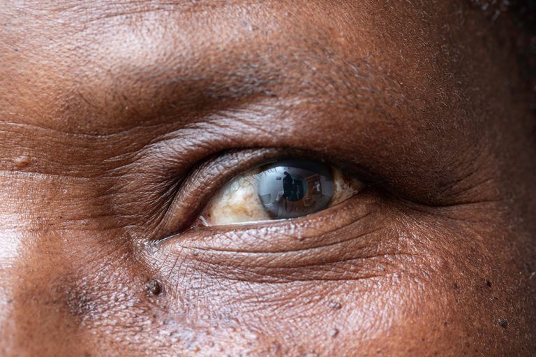 65ba617a53ba3afcfc475612 Cloudy Vision Should You Be Worried About Cloudy Vision?