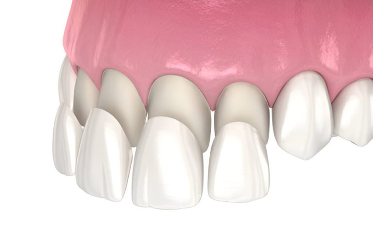 killen FI 1024x627 1 Types of Dental Veneers: Find the Best Option for Your Smile