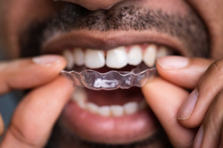 607a381f923ae7bf712d315f AdobeStock 309502612 scaled 1 Invisalign Treatments: The Clear Path to a Perfect Smile