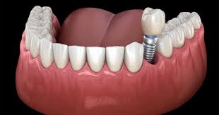 images How Dental Implants Became the Top Choice for Adult Tooth Loss