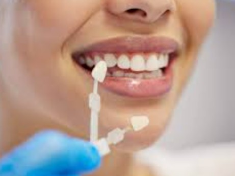 Screenshot 394 Leading London Dentists Reveal 8 Veneers London Preparation Essentials