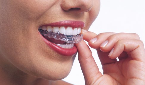 G Invisalign 02 Teeth Straightening Guide: Hidden Costs and Real Concerns