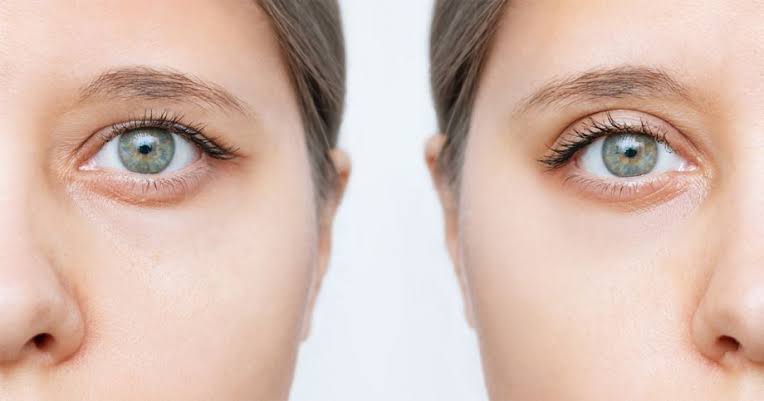 Eyelid Surgery Advice: What To Know Before Your Procedure 1 images 3 Eyelid Surgery Advice: What To Know Before Your Procedure
