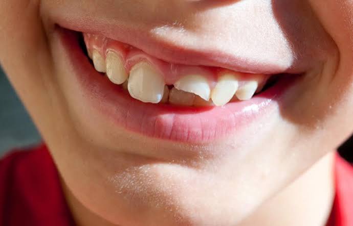images 2026 10 24T174044.470 How Dentists Fix Broken Teeth and Restore Smiles